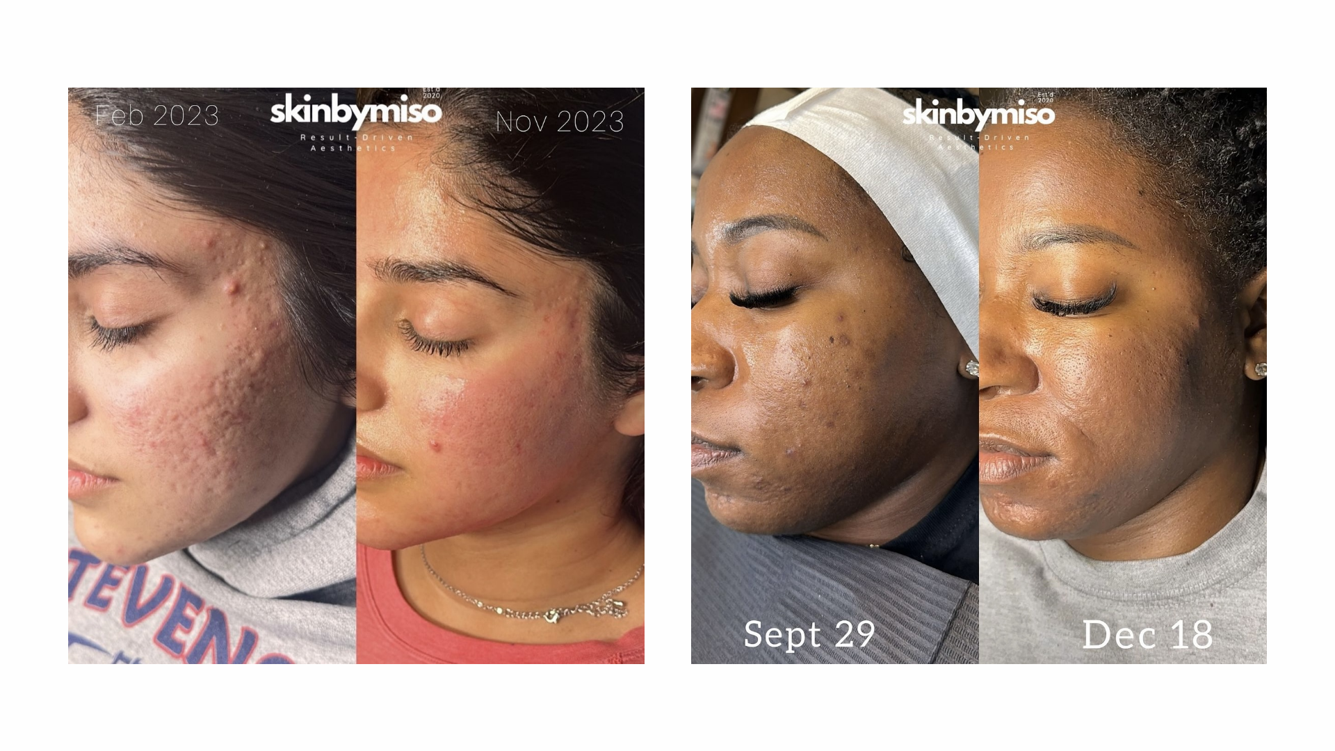 Beautiful skin transformations offered by licensed esthetician at the SkinByMiso Med Spa and Salon facility in Dearborn, Michigan