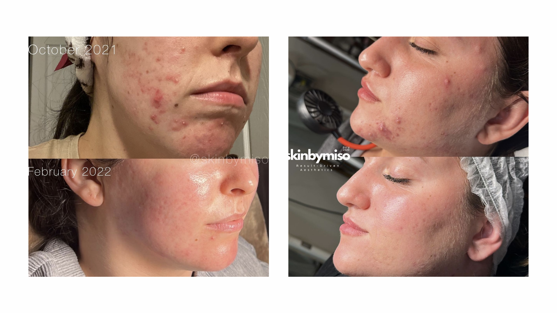 Beautiful skin transformations offered by licensed esthetician at the SkinByMiso Med Spa and Salon facility in Dearborn, Michigan