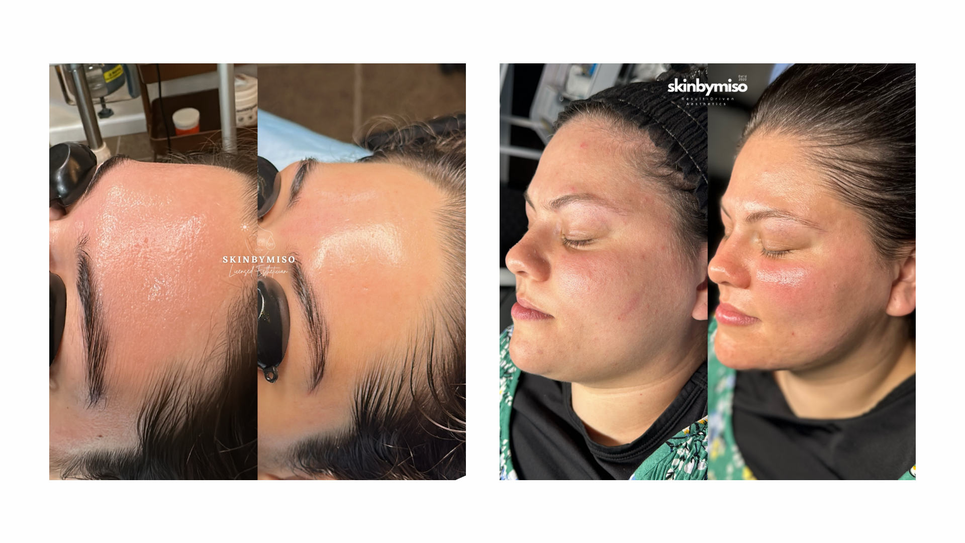 Beautiful skin transformations offered by licensed esthetician at the SkinByMiso Med Spa and Salon facility in Dearborn, Michigan