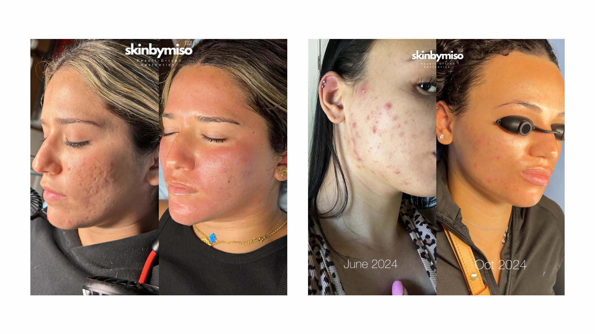 Beautiful skin transformations offered by licensed esthetician at the SkinByMiso Med Spa and Salon facility in Dearborn, Michigan