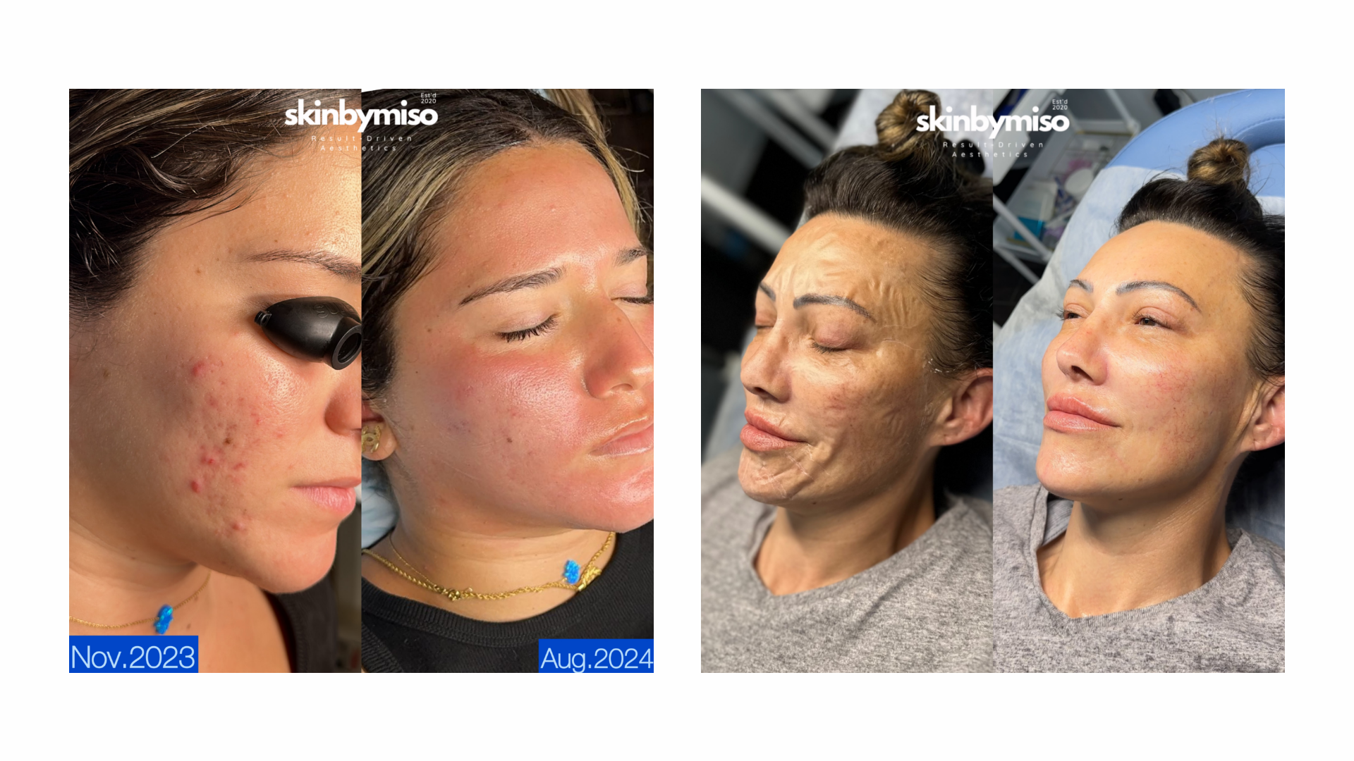 Beautiful skin transformations offered by licensed esthetician at the SkinByMiso Med Spa and Salon facility in Dearborn, Michigan