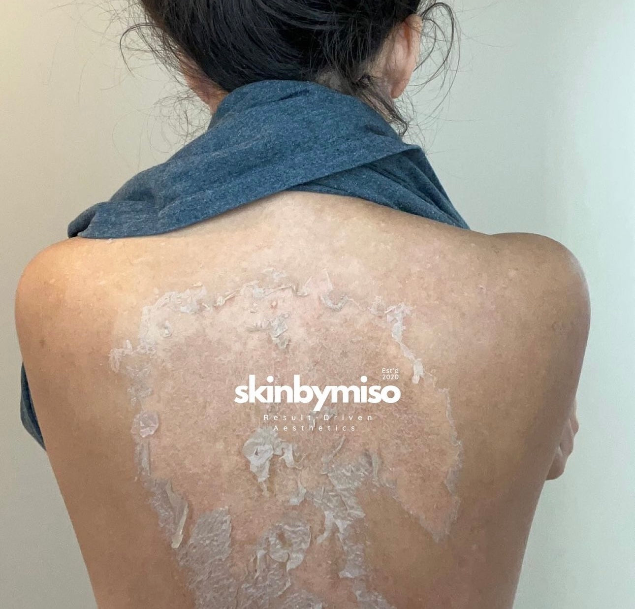 ZENA back peel offered by licensed estheticians at SkinByMiso in Dearborn, Michigan