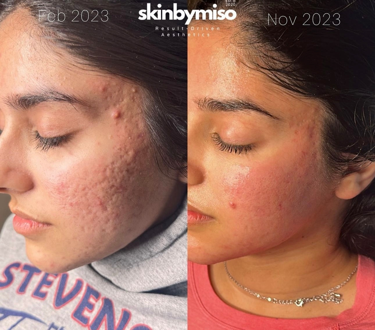 Zena cosmetics algae peel transformation offered by licensed esthetician at the SkinByMiso Med Spa and Salon facility in Dearborn, Michigan