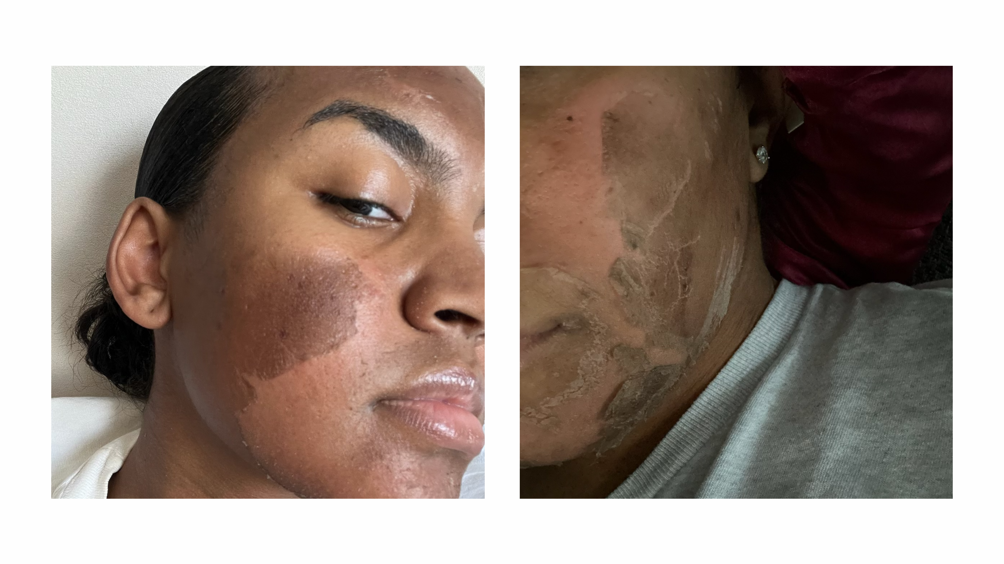 Zena cosmetics algae peel transformation offered by licensed esthetician at the SkinByMiso Med Spa and Salon facility in Dearborn, Michigan