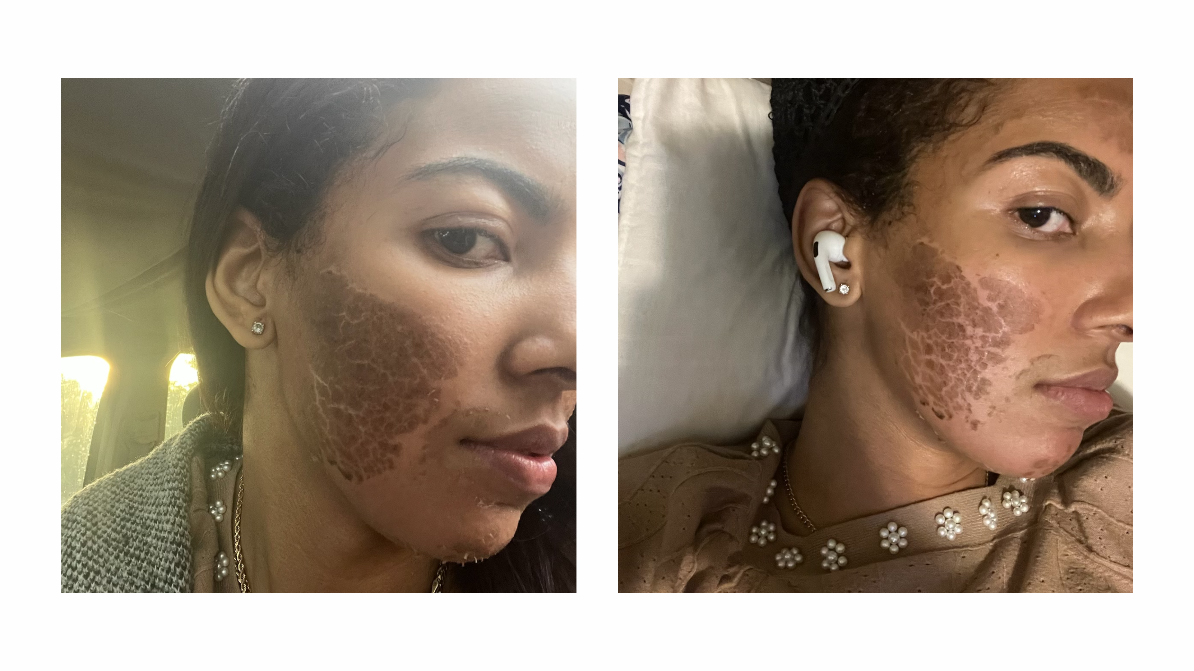 Zena cosmetics algae peel transformation offered by licensed esthetician at the SkinByMiso Med Spa and Salon facility in Dearborn, Michigan