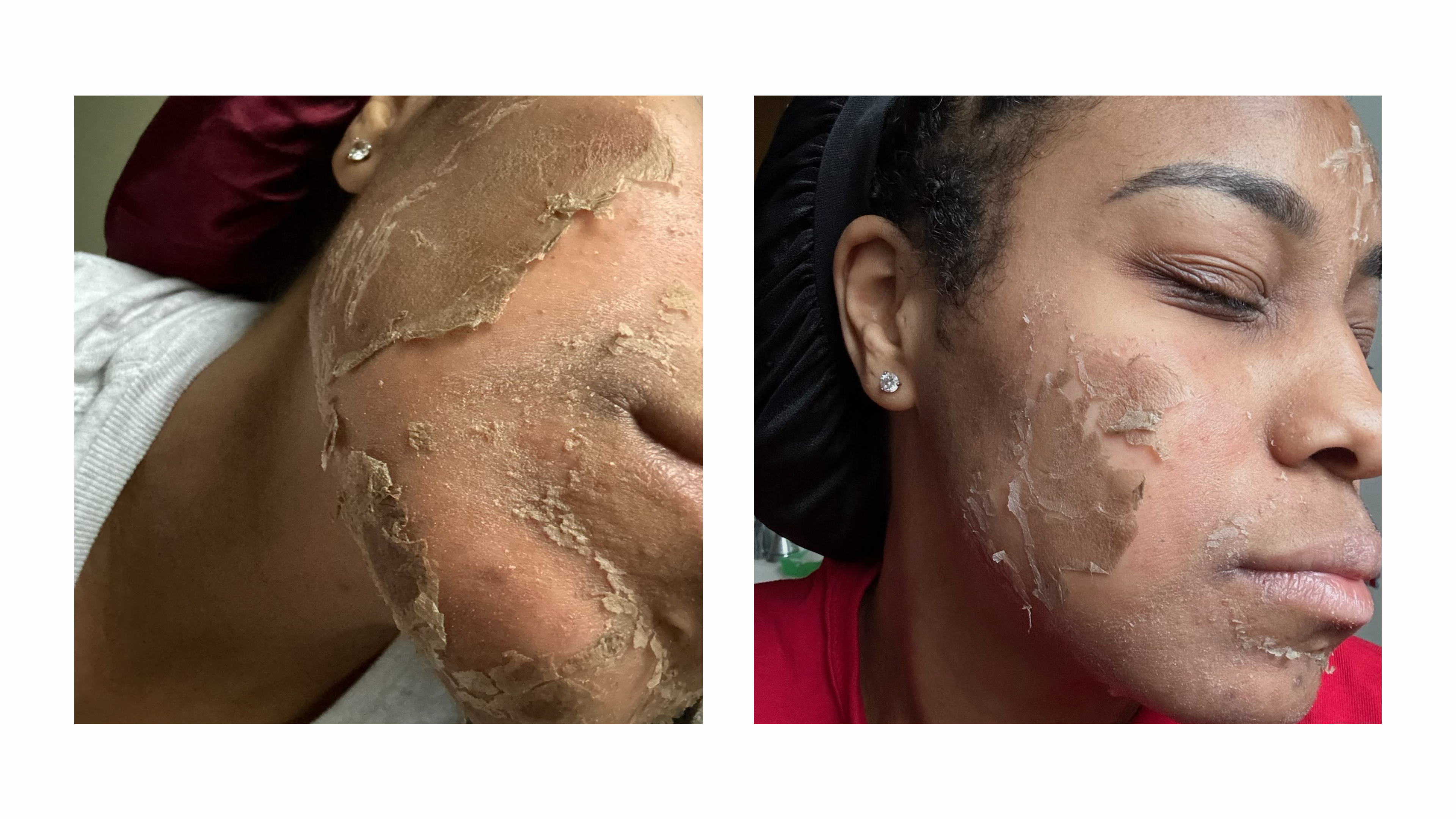 Zena cosmetics algae peel transformation offered by licensed esthetician at the SkinByMiso Med Spa and Salon facility in Dearborn, Michigan