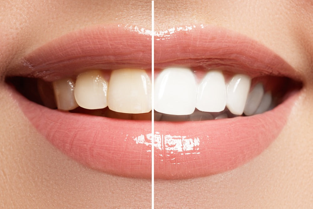 Professional teeth whitening salon services offered at SkinByMiso Med Spa and Salon in Dearborn, Michigan